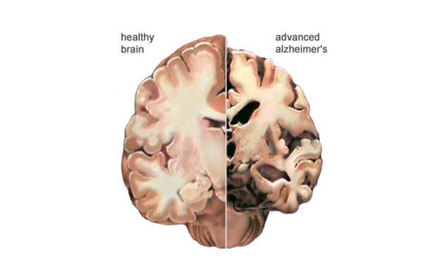 Alzheimer brain