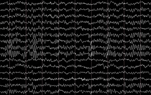 electroencephalogram