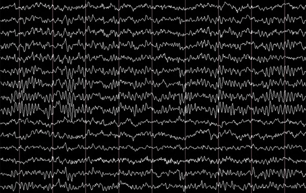 electroencephalogram