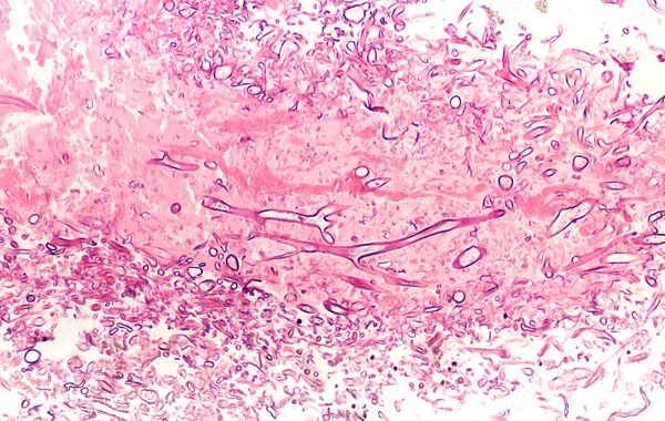 mucormycosis